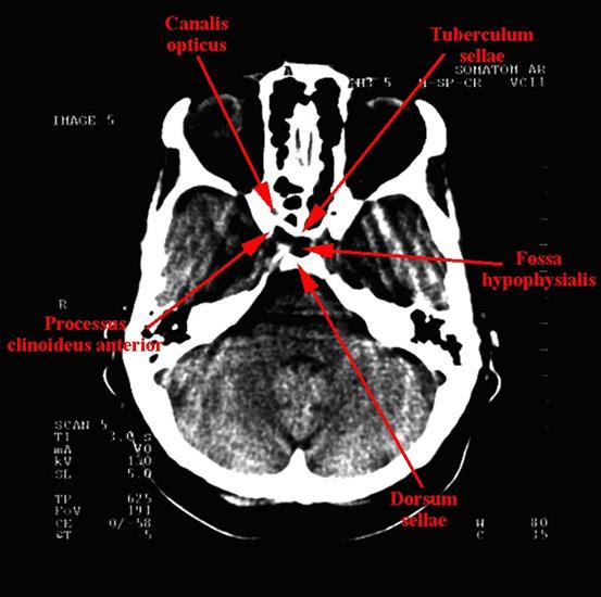 tomografia komputerowa głowy - 04b.jpg